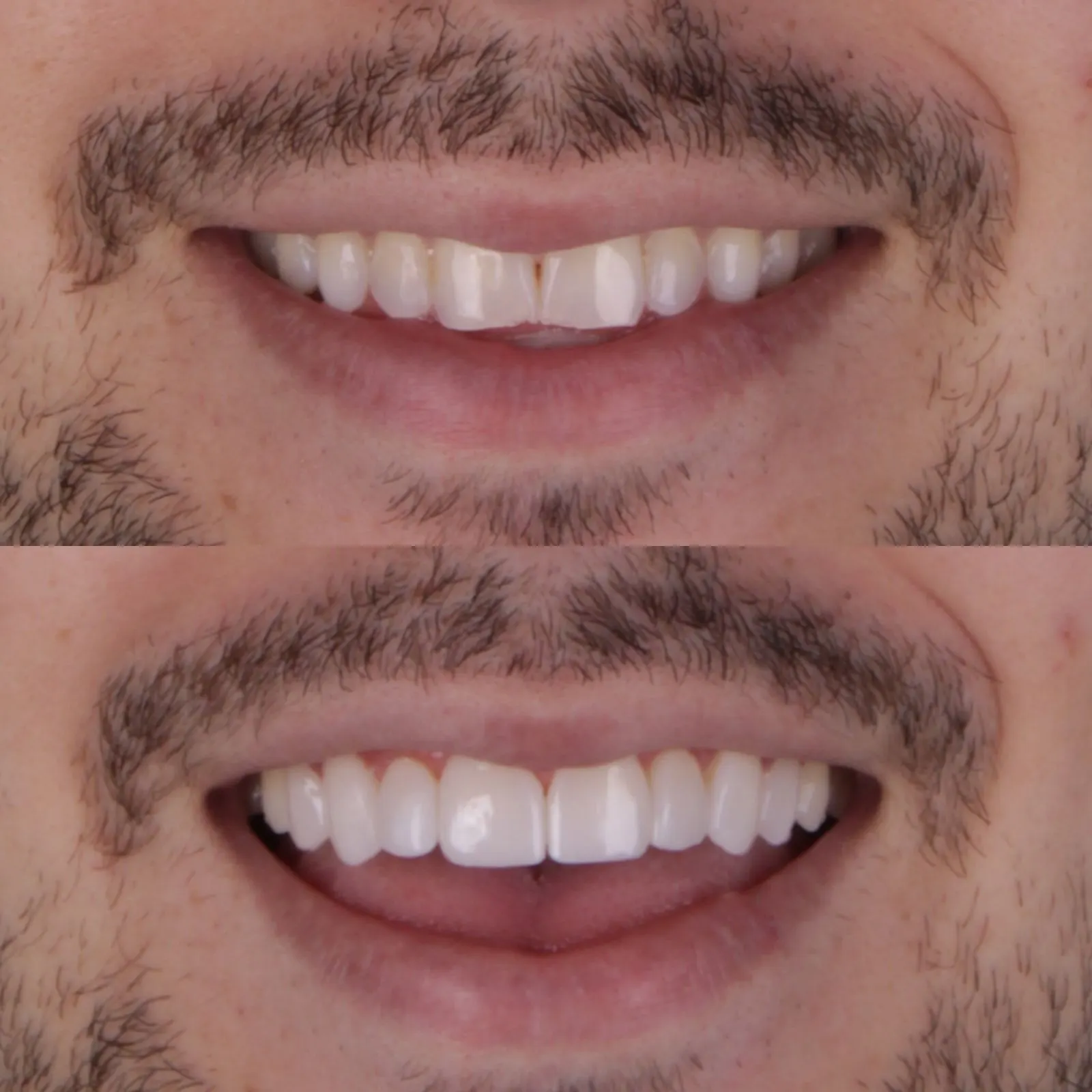 Antes e Depois