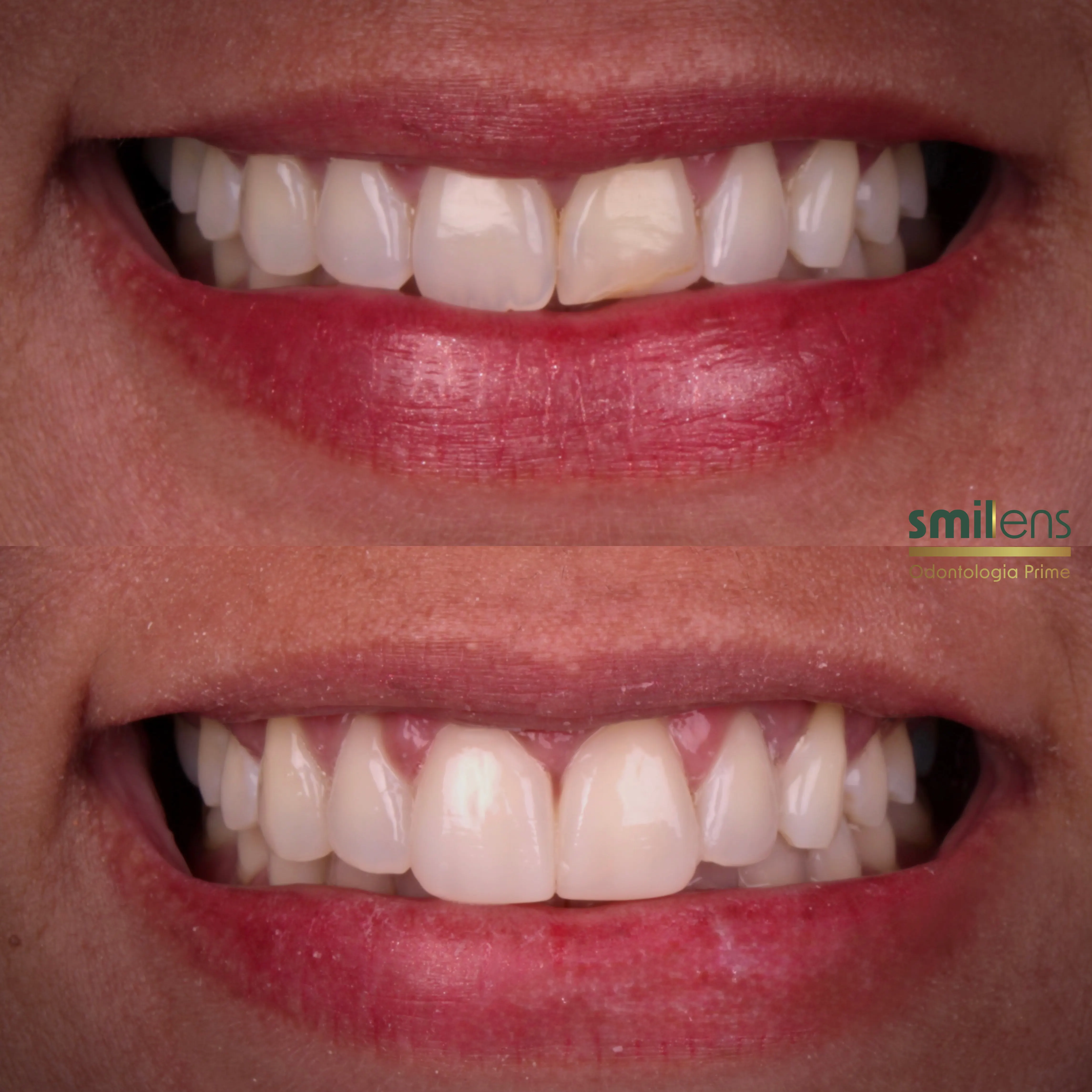 Antes e Depois