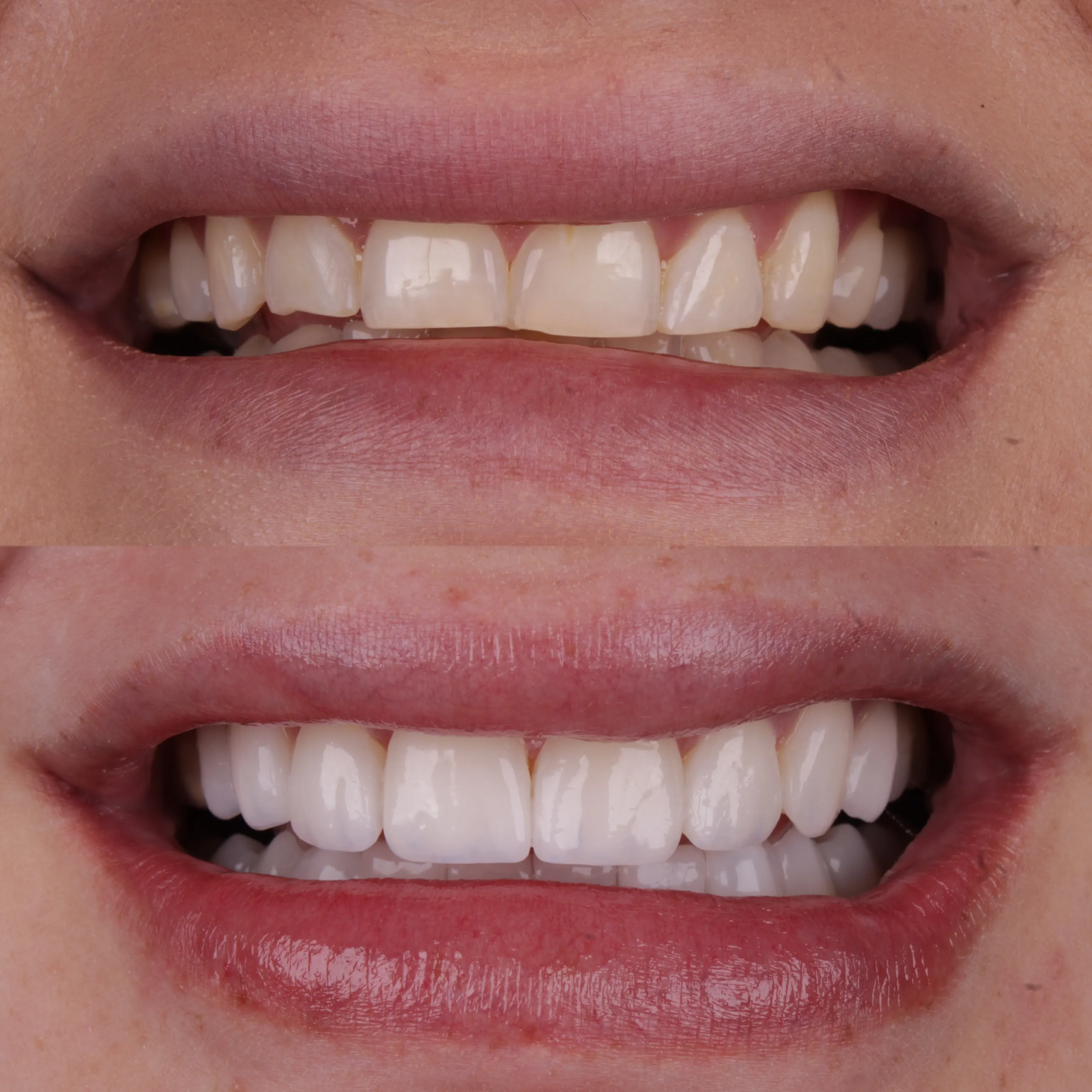 Antes e Depois