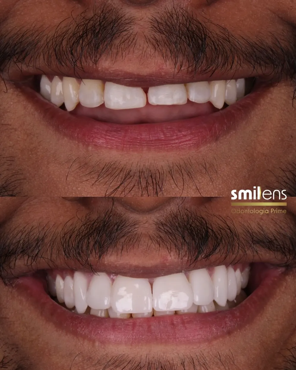 Antes e Depois