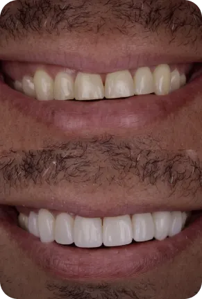 Antes e Depois